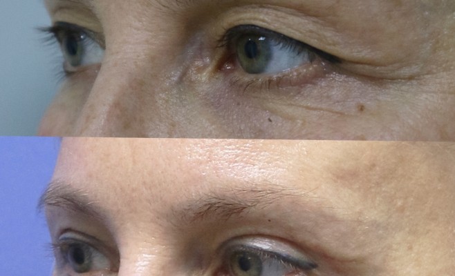 верх блеф 1 мес п_о 