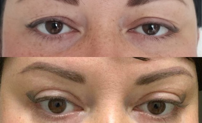 верх блеф 30 лет до и после 